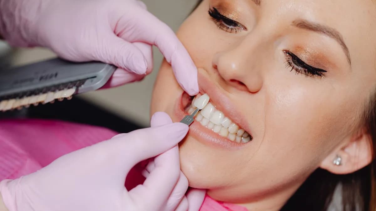 Dentista adhiriendo una carilla a un diente preparado