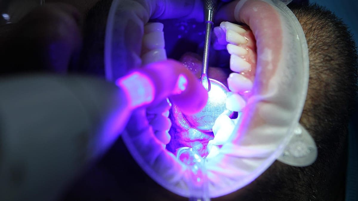 Blanqueamiento Dental en Turquía: Opciones, Resultados y Duración
