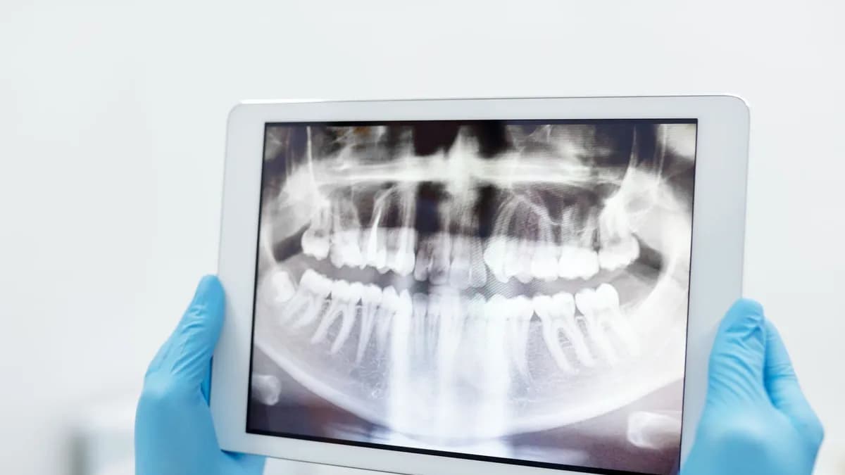 Panoramic X-ray used to plan All-on-4 implant positions