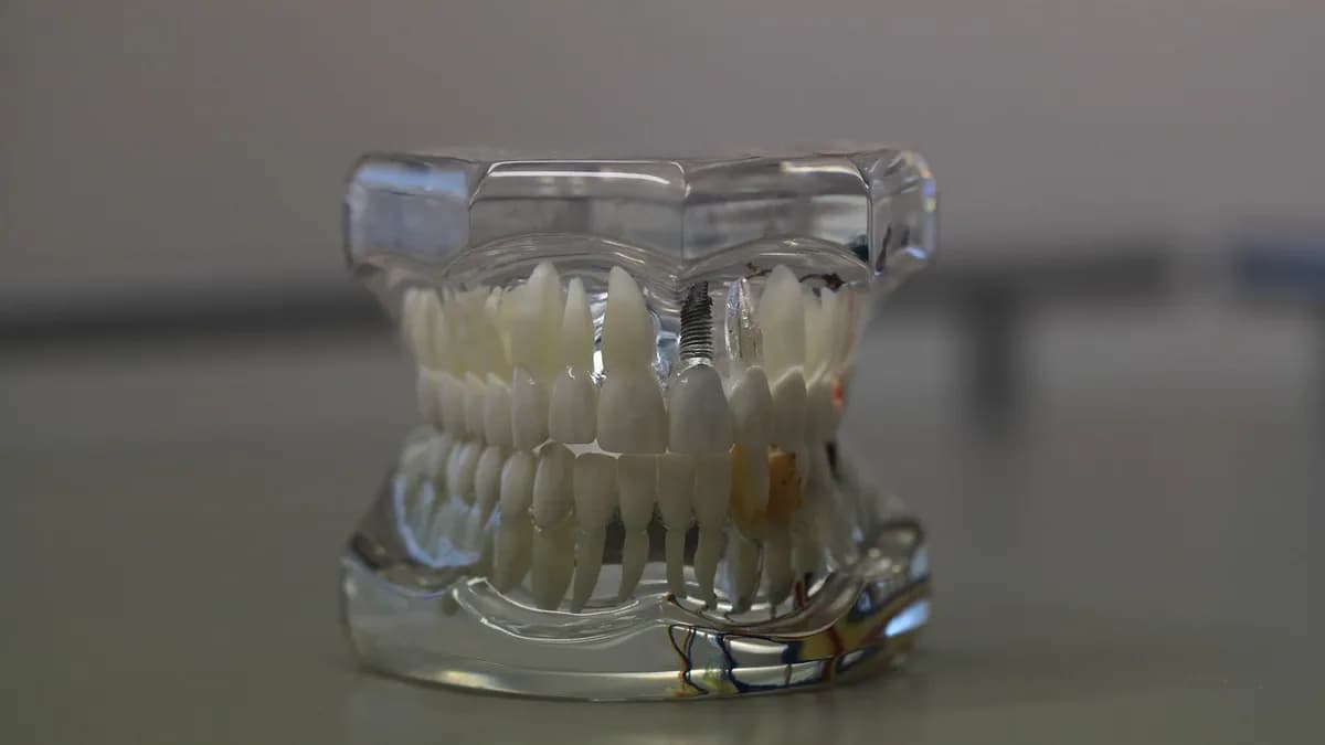 Titanium implant models showing four and six implant layouts