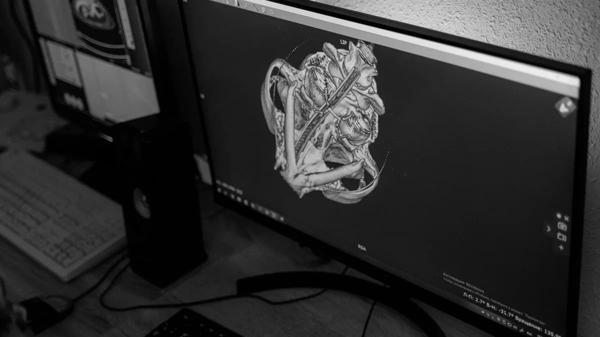 3D CT scan screen used to plan implant number and position
