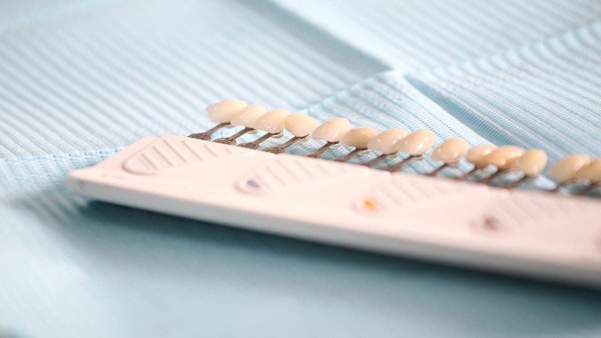 ¿Carillas o Blanqueamiento? Qué Necesita Realmente tu Sonrisa